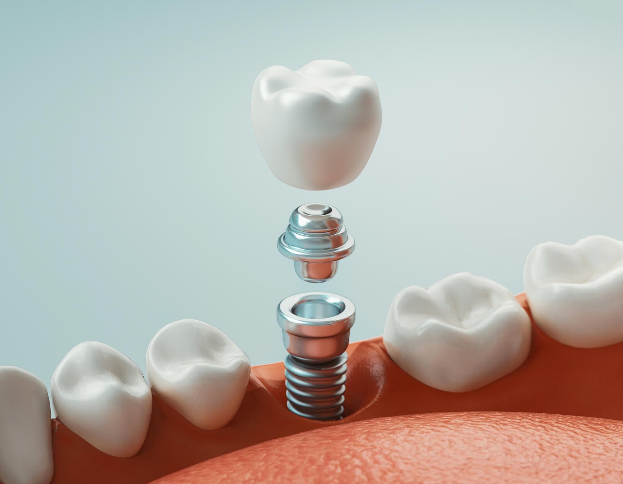 Implants Tooth Replacement