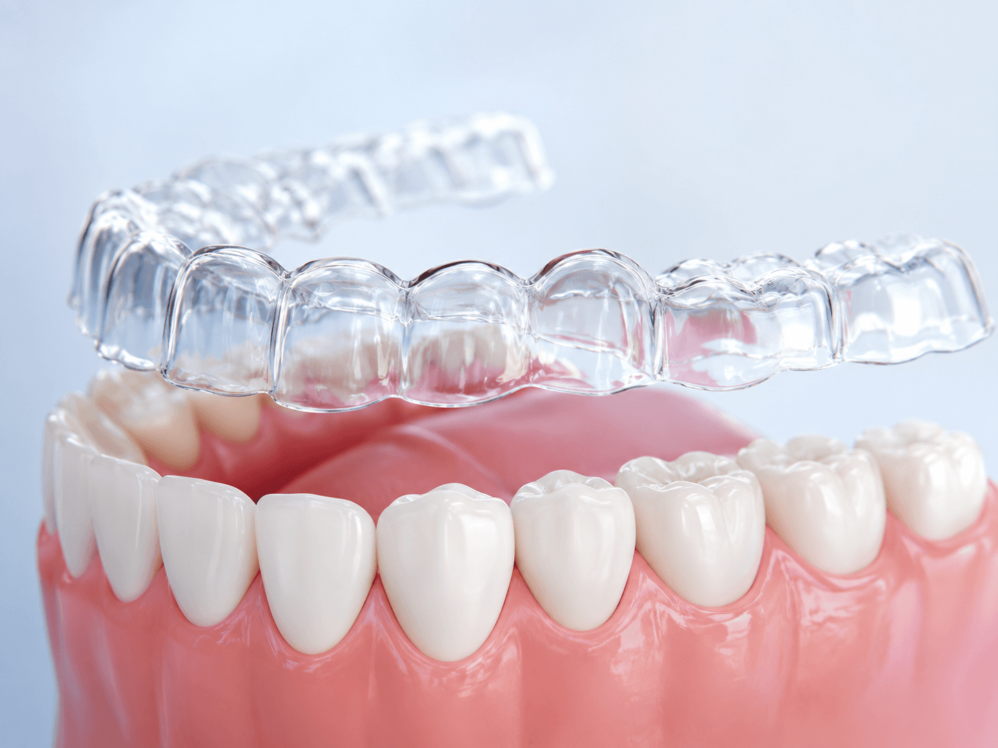 Custom Retainers