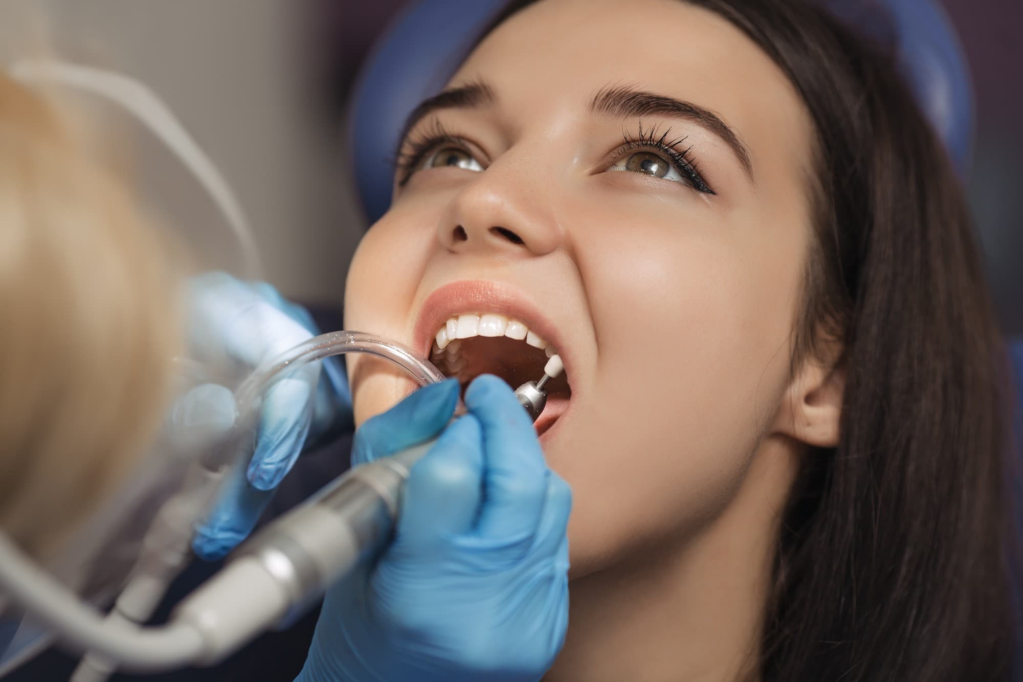Teeth Cleaning (Deep)