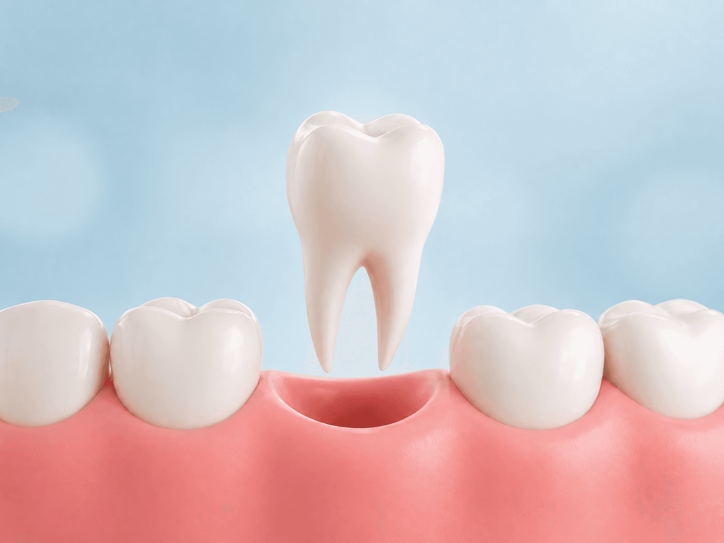 Tooth Extractions