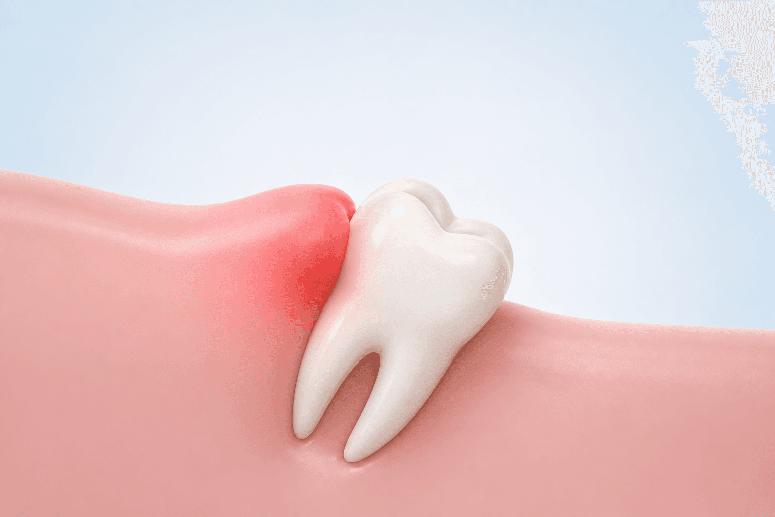 Wisdom Tooth Infection